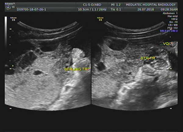 anh-sieu-am-buong-trung-1 siêu âm buồn trứng