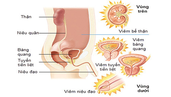Bệnh nhiễm trùng đường tiểu
