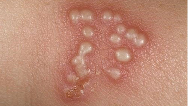 benh-sui-mao-ga-o-nu-1 Bẹnh sùi mào gà ở nữ