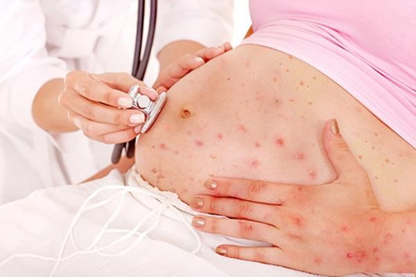 Bị ngứa nổi mẫn lúc mang thai