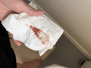 Dấu hiểu sảy thai