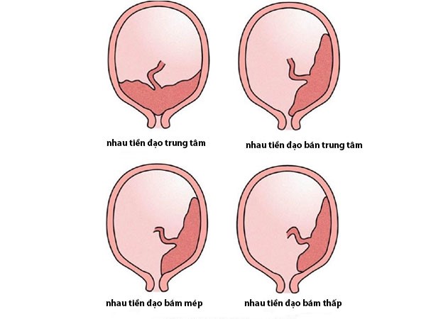 Các loại nhau tiền đạo