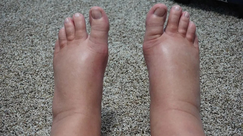 Cách giảm phù chân cho bà bầu