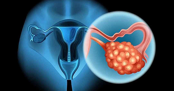 Căn bệnh nguy hiểm ở phụ nữ