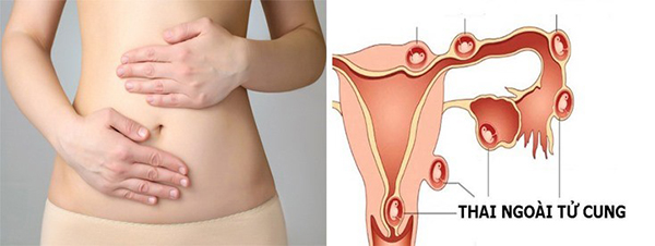 Cẩn thận khi mang thai ngoài tử cung