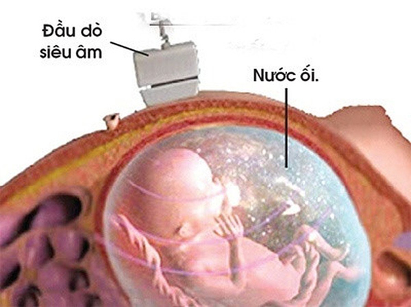 Chọc ối có nguy hiểm không