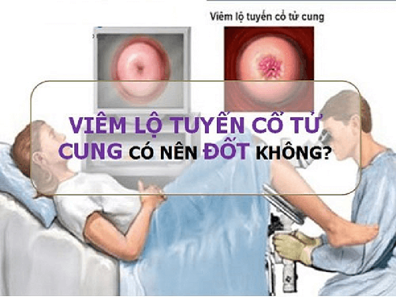 Có nên đốt viêm lộ tuyến cổ tử cung