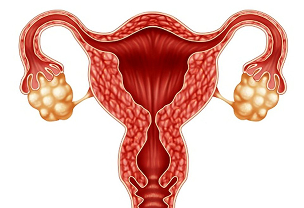 Đa nang buồng trứng có nguy hiểm không