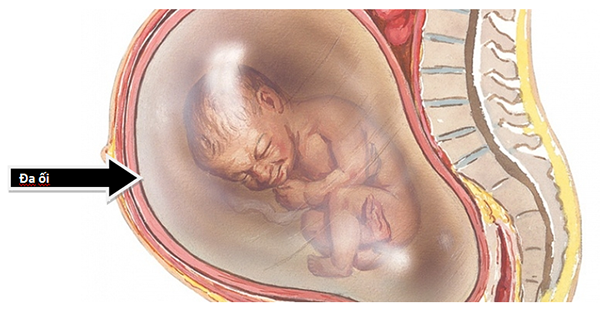 da-oi-co-nguy-hiem-khong-2 Đa ối có nguy hiểm không còn phụ thuộc vào lượng nước ối bị dư thừa