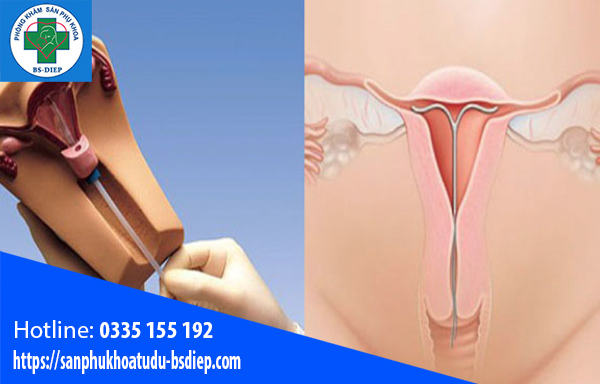 dat-vong-tranh-thai1-3 Đặt vòng tránh thai khi nào