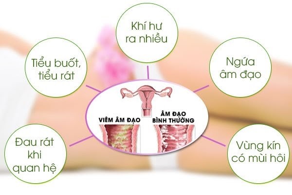 dau-hieu-bu-nam-candida Những dấu hiệu thường gặp khi bị bệnh nấm Candida