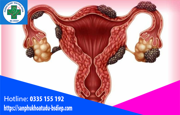 Dấu hiệu lạc nội mạc tử cung