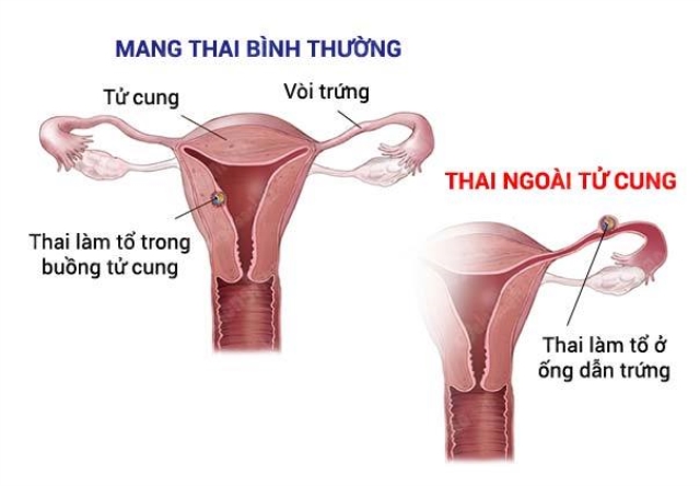 Dấu hiệu thai ngoài tử cung