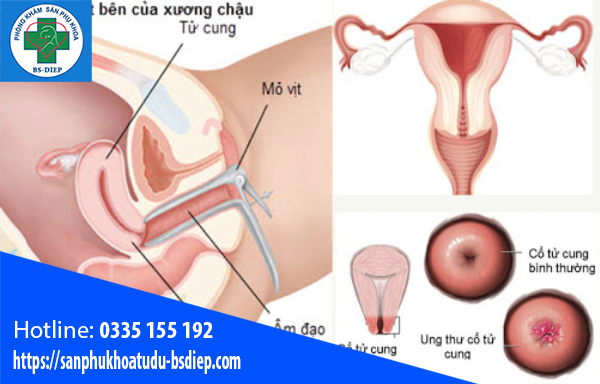 Mô phỏng dấu hiệu nhận biết bệnh cổ tử cung