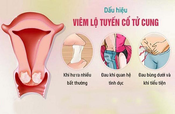 Viêm lộ tuyến cổ tử cung