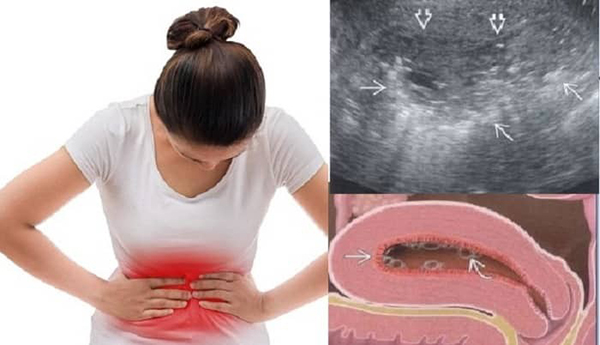 Dấu hiệu viêm nội mạc tử cung