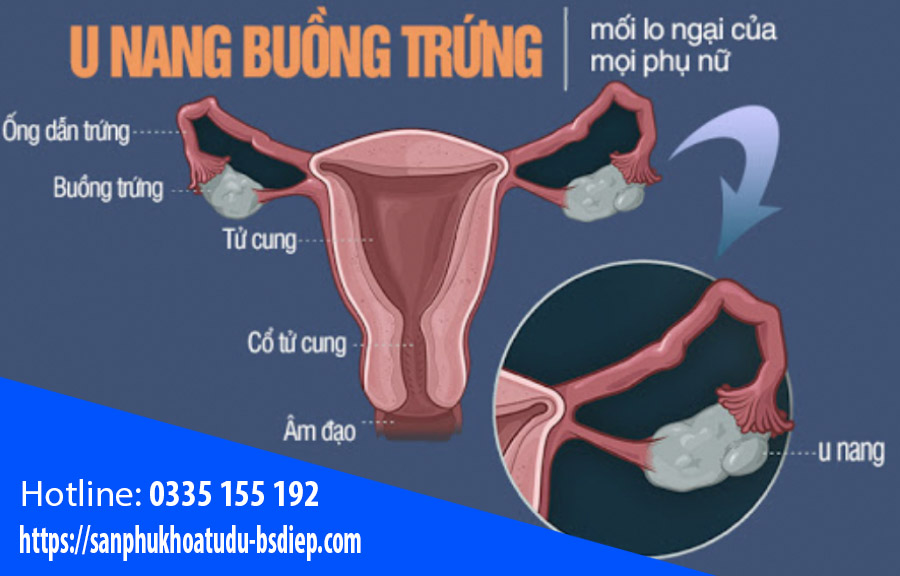 Điều trị u nang buồng trứng