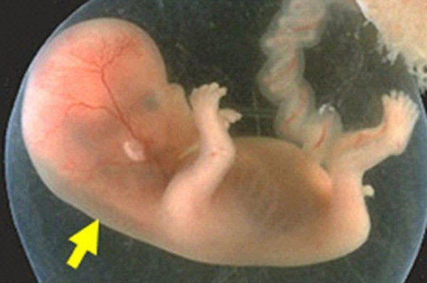 Độ mờ da gáy là chỉ số quan trọng để theo dõi sức khỏe thai nhi