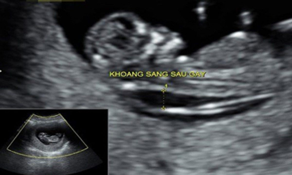 Độ mờ da gáy bình thường hay không sẽ phản ánh dị tật thai nhi và bệnh Down