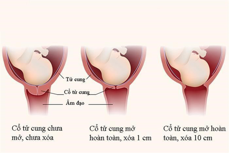 Giai đoạn đau mẹ bàu phải vượt qua