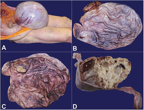 Hình ảnh khối u buồng trứng
