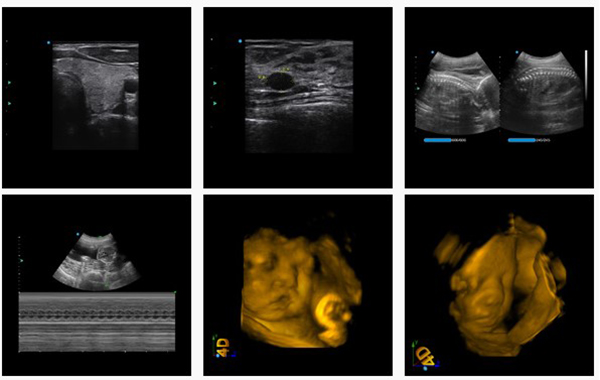 Hình ảnh siêu âm 2D