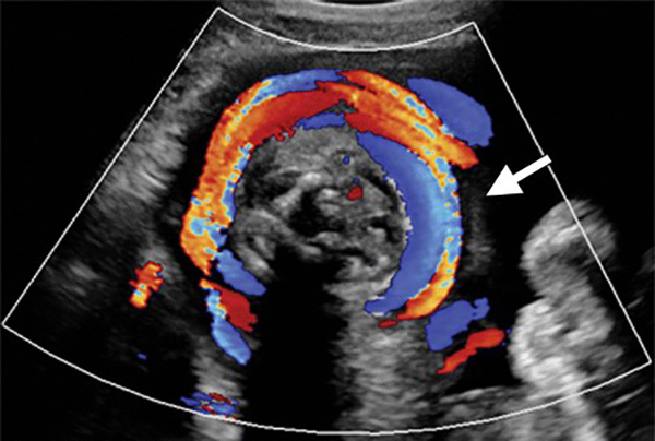 hinh-anh-sieu-am-day-ron-quan-co Hình ảnh siêu âm dây rốn quấn cổ