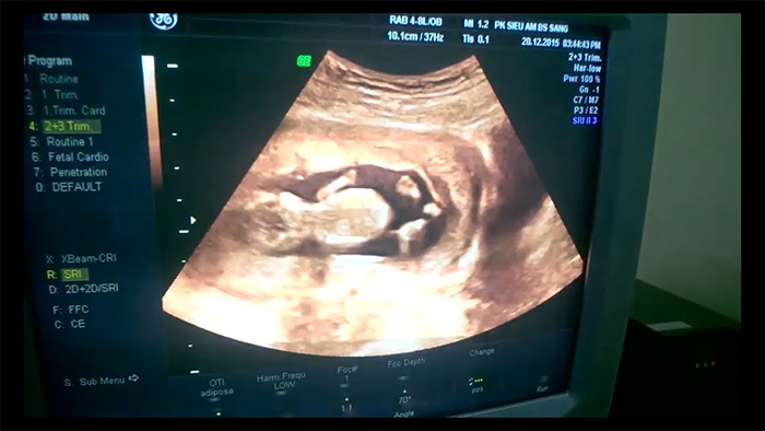 Hình ảnh thai 12 tuần