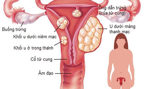 Khối nhân xơ tử cung