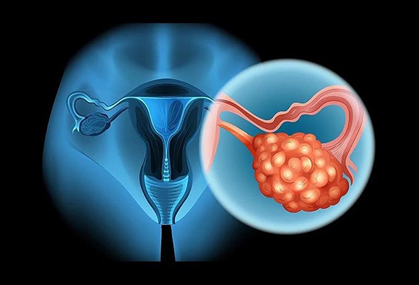 Khối u nang buồng trứng ác tính