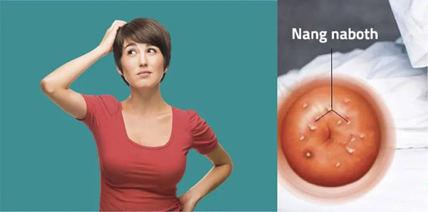 Bạn cần kiêng quan hệ tình dục khi điều trị nang Naboth