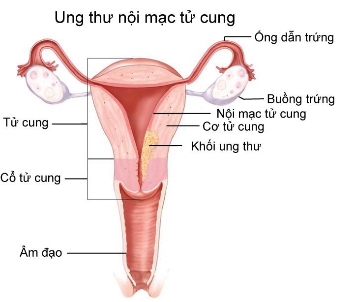 lac-noi-mac-tu-cung-43 Lạc nội mạc tử cung