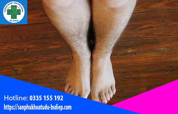 Long rậm - biểu hiện của đa nang buồng trứng