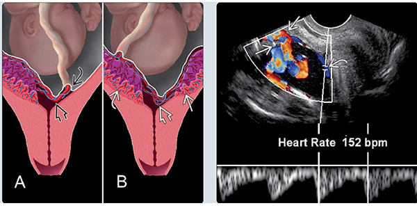 mach-mau-tien-dao Mạch máu tiền đạo