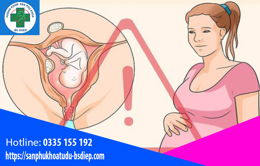 Mang thai khi bị u xơ tử cung