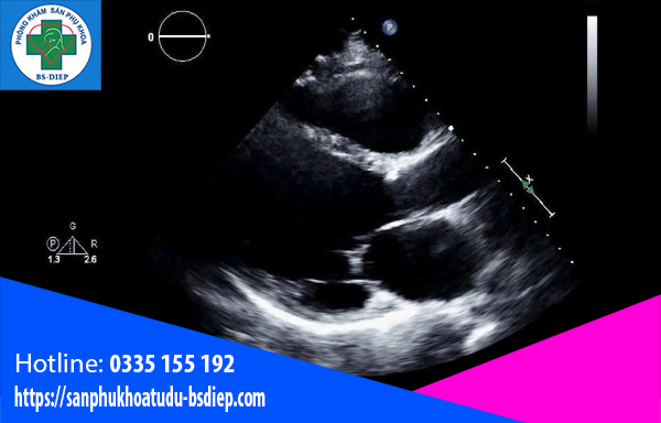 may-tuan-co-tim-thai Không nghe được nhịp tim của thai nhi có thể là dấu hiệu của việc mẹ bầu đã mất đi bé cưng