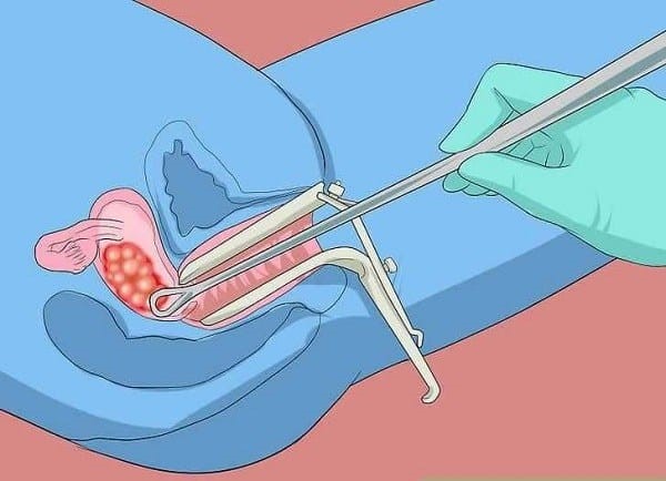 Phương pháp điều trị phổ biến nhất là nong cổ tử cung để nạo, hút sạch thai trứng ra khỏi tử cung