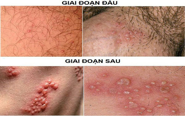 mun-rop-sinh-duc Mụn rộp sinh dục