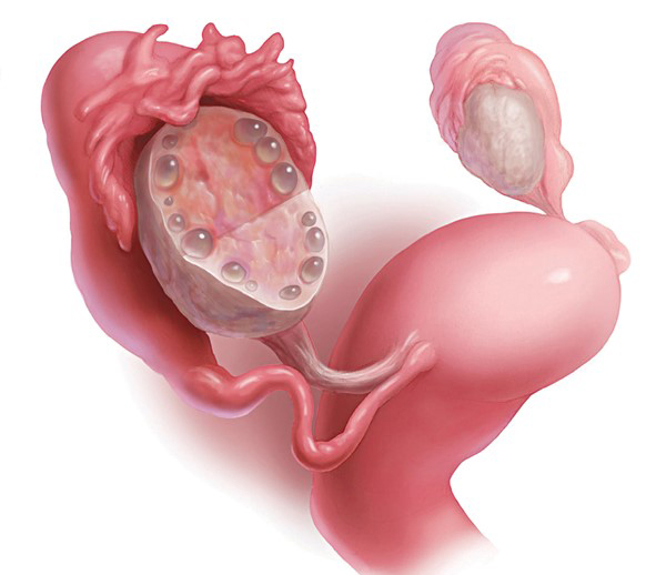 Nang buồng trứng