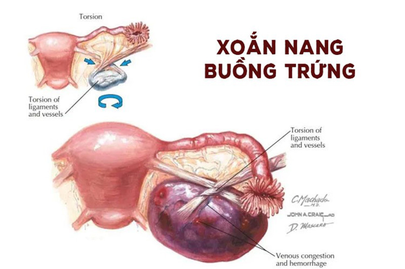 nguyen-nhan-xoan-nang-buong-trung Nguyên nhân oắn nang buồng trứng