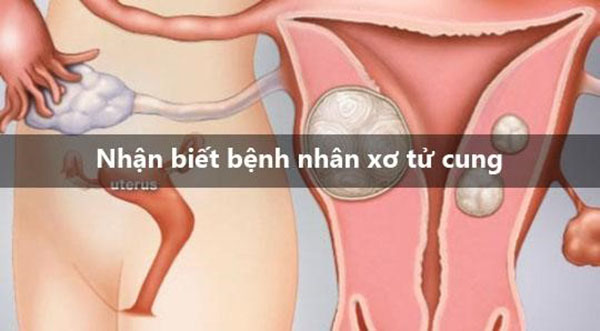 nhan-biet-nhan-xo-tu-xung Nhân xơ tử cung