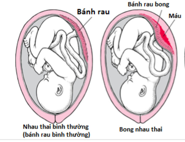 nhau-bong-non Nhau bong non