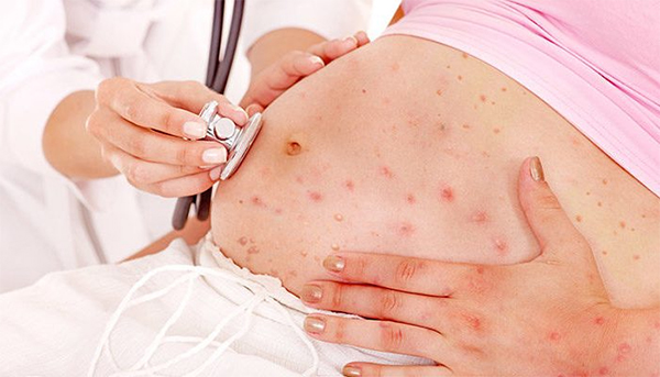 Nhiễm Rubella khi mang thai