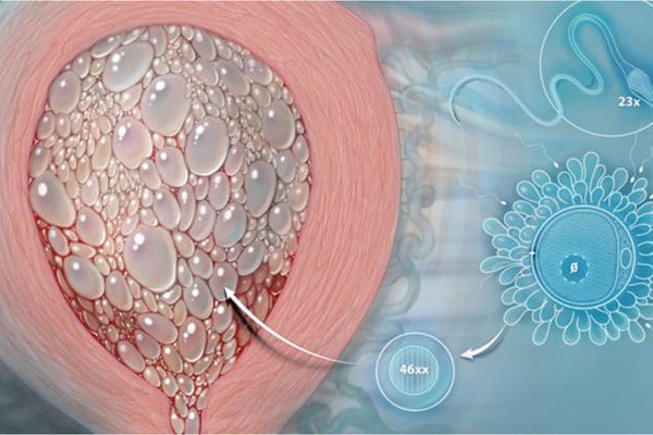 Trường hợp chửa trứng bán phần, nhiễm sắc thể của mẹ vẫn được bảo tồn xong của người cha có đến hai bộ nhiễm sắc thể