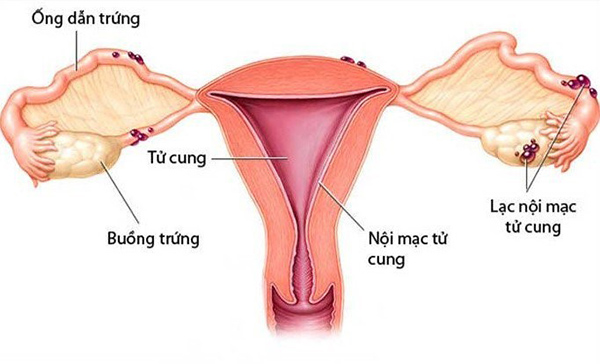 Niêm mạc tử cung mỏng
