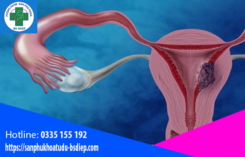 Phát hiện u nang buồng trứng trái