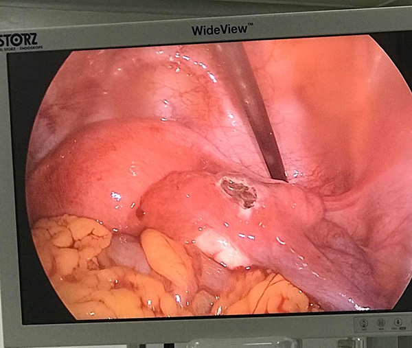 Phẫu thuật nội soi loại thai ngoài tử cung