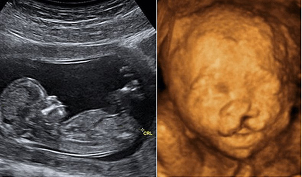 Siêu âm nhiều có hại cho thai nhi không?