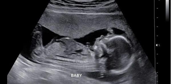 siêu âm sàng lọc nguy cơ tiền sản giật