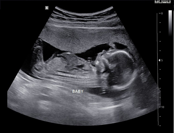 Siêu âm 3 tháng đầu là điều bác sĩ khuyến nghị thai phụ thực hiện